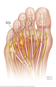 Morton's Neuroma by Mayo Clinic