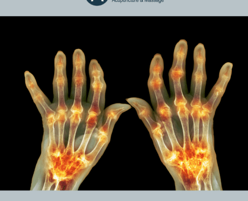 Acupuncture For Arthritis