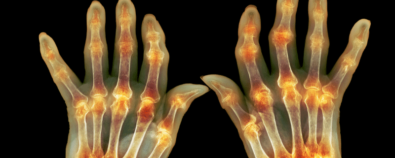 Acupuncture For Arthritis