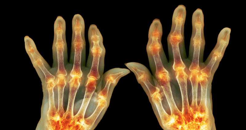 Acupuncture For Arthritis