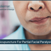 Acupuncture For Partial Facial Paralysis Acupuncture For Partial Facial Paralysis- Ackerman Acupuncture