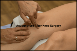Acupuncture After Knee Surgery